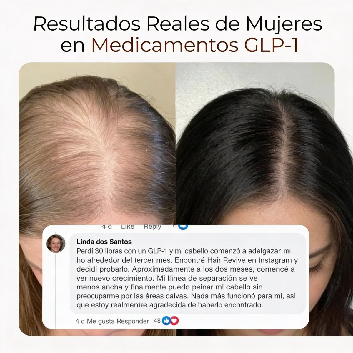 Detén la Caída de Cabello por GLP-1 y Recupera Tu Confianza